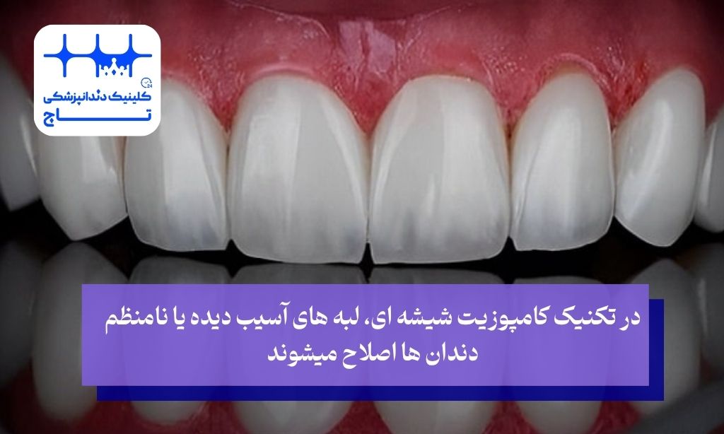 ضرورت استفاده از کامپوزیت شیشه ای دندان