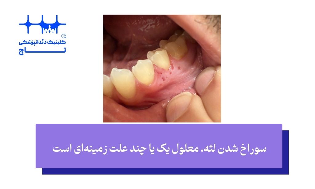 علت سوراخ شدن لثه چیست