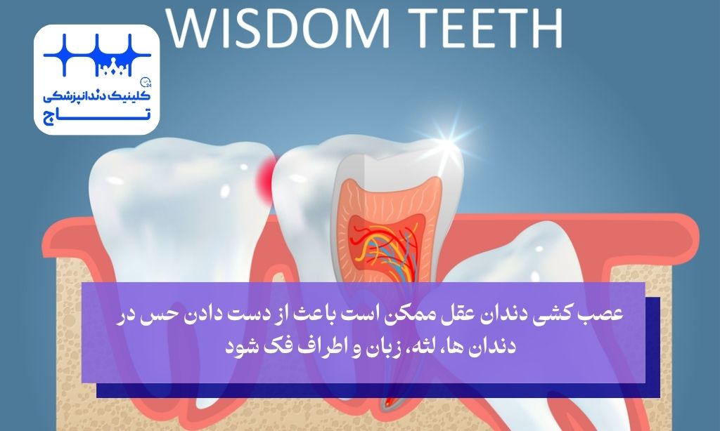 عوارض عصب کشی دندان عقل