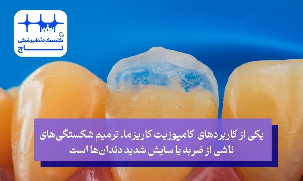 کامپوزیت برای ترمیم دندان