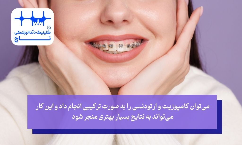 آیا می‌توان کامپوزیت و ارتودنسی را با هم انجام داد