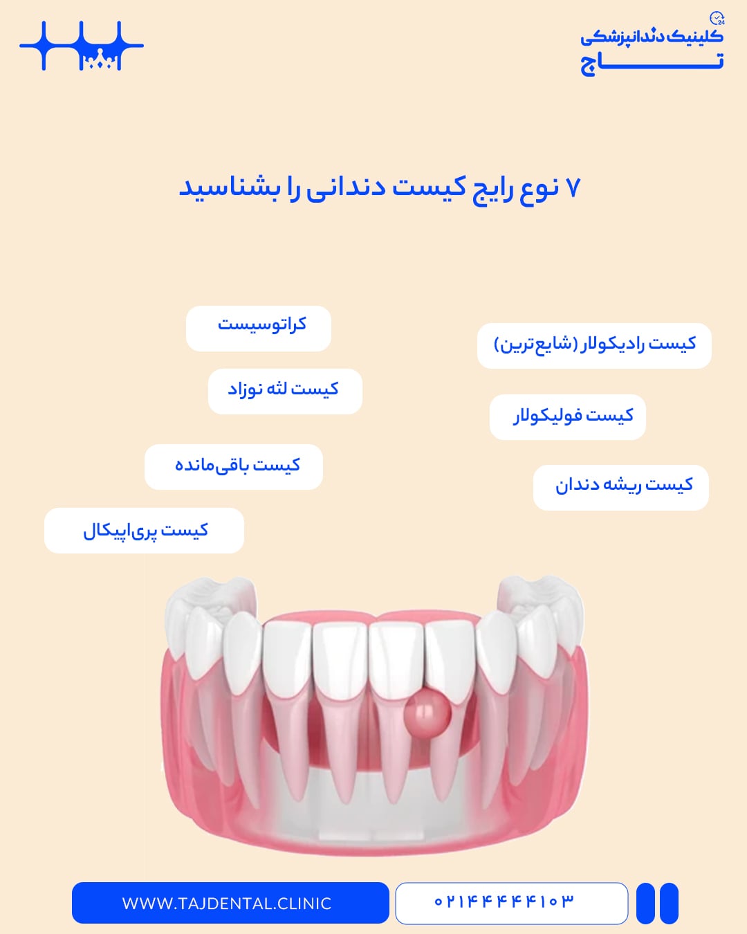انواع کیست‌های دندانی