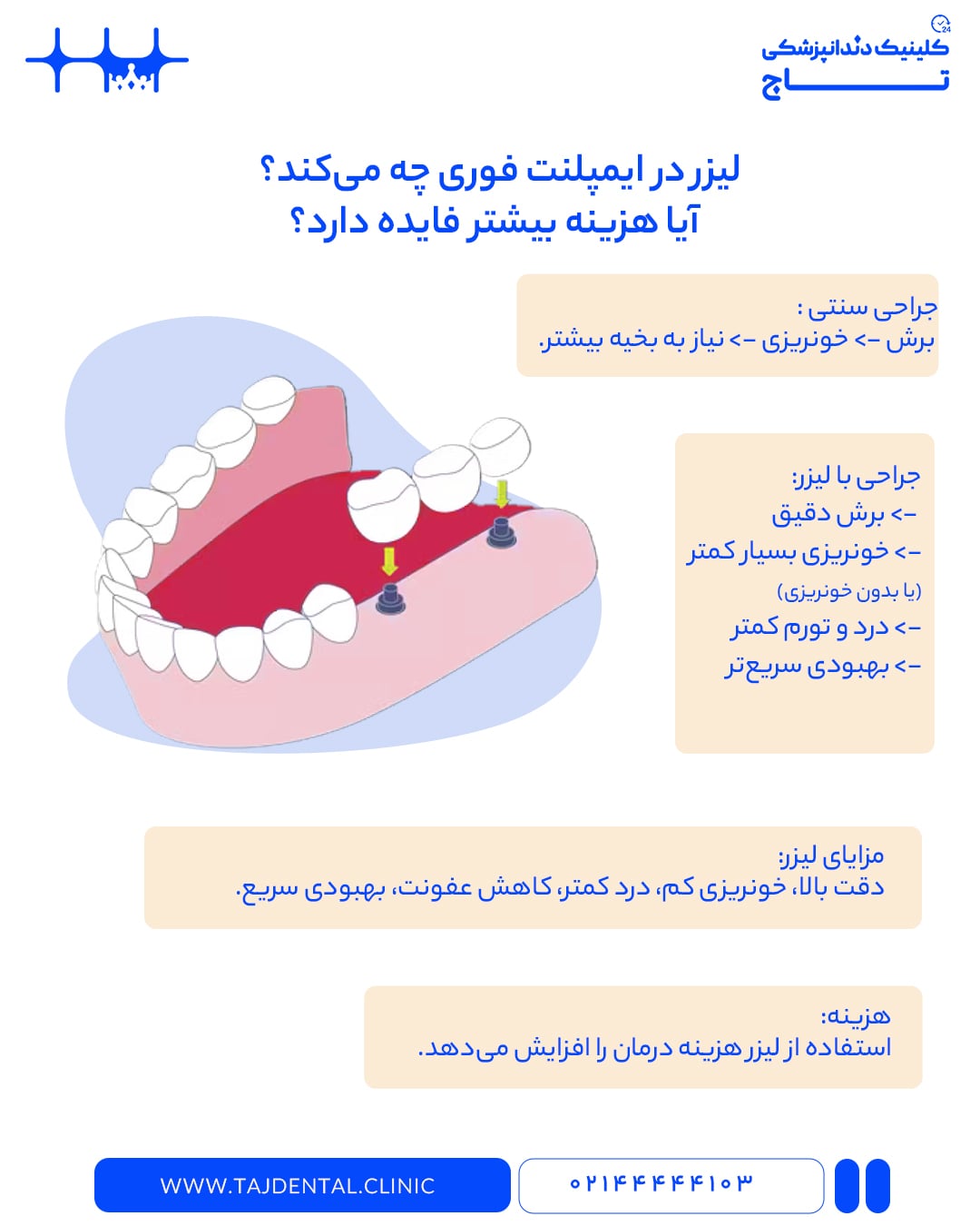 ایمپلنت فوری با لیزر