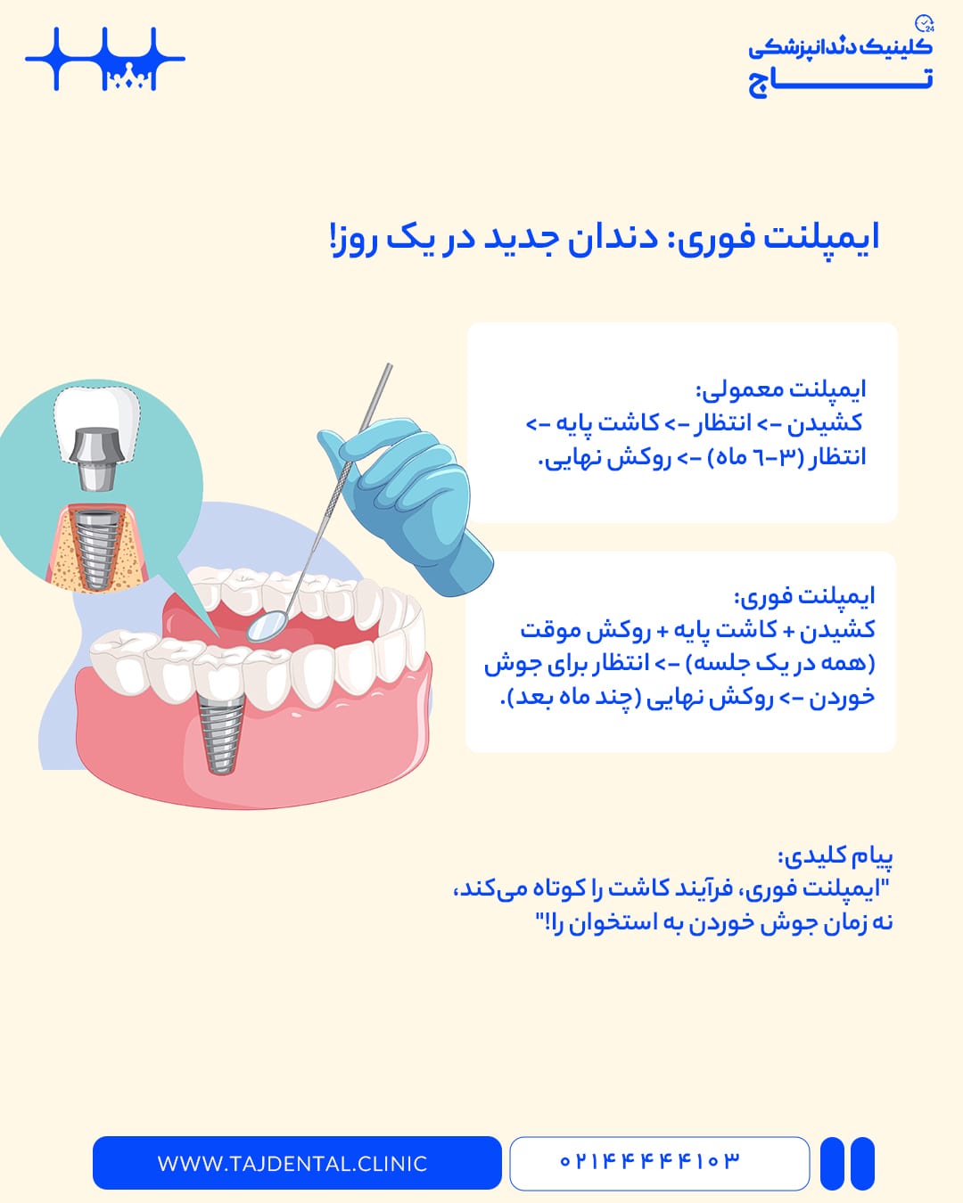 ایمپلنت فوری چیست