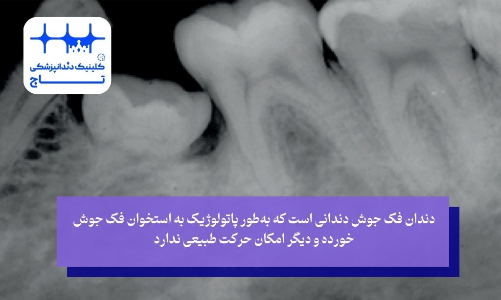 تفاوت دندان فک جوش با دندان نهفته