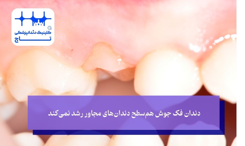 چطور می‌توانیم دندان فک جوش را تشخیص دهیم