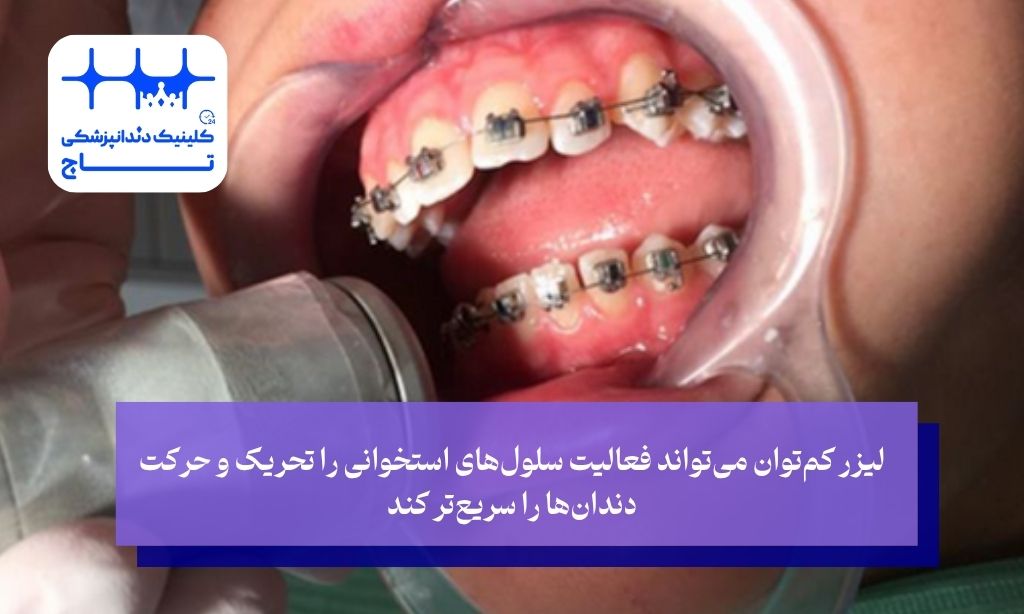 کاربردهای کلیدی لیزر در فرایند ارتودنسی