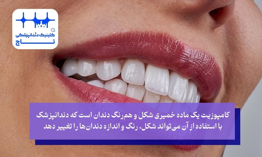 کامپوزیت دندان چیست
