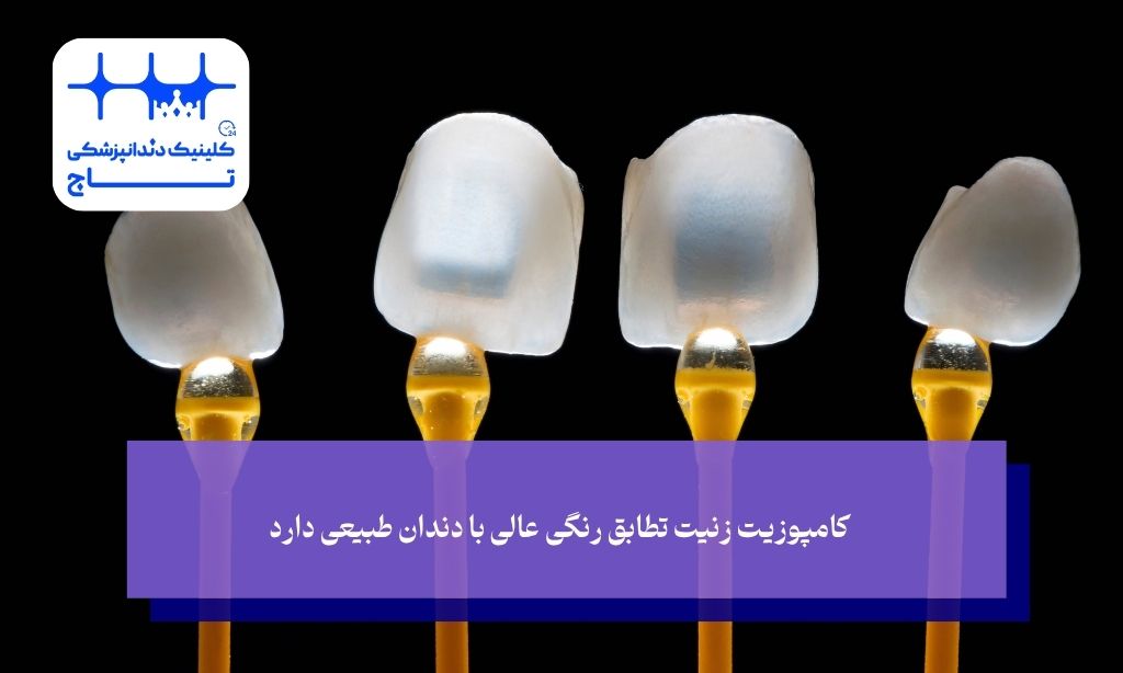  کامپوزیت زنیت تطابق رنگی عالی با دندان طبیعی دارد