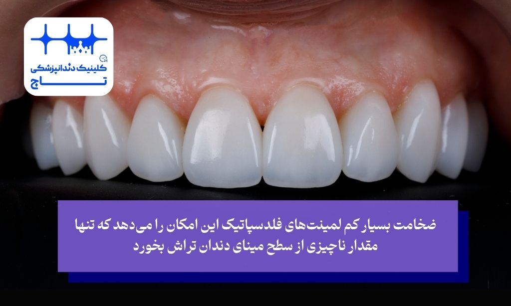 مزایای خیره‌کننده لمینت فلدسپاتیک؛ فراتر از یک لبخند زیبا