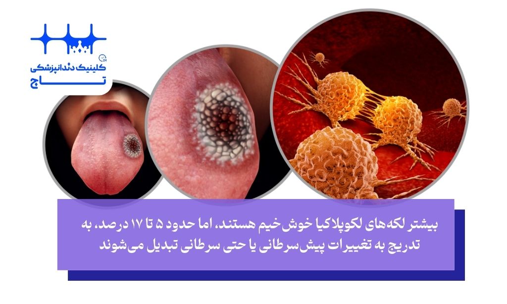 آیا لوکوپلاکی خطرناک است