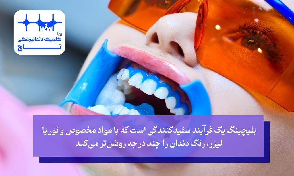 بلیچینگ دندان