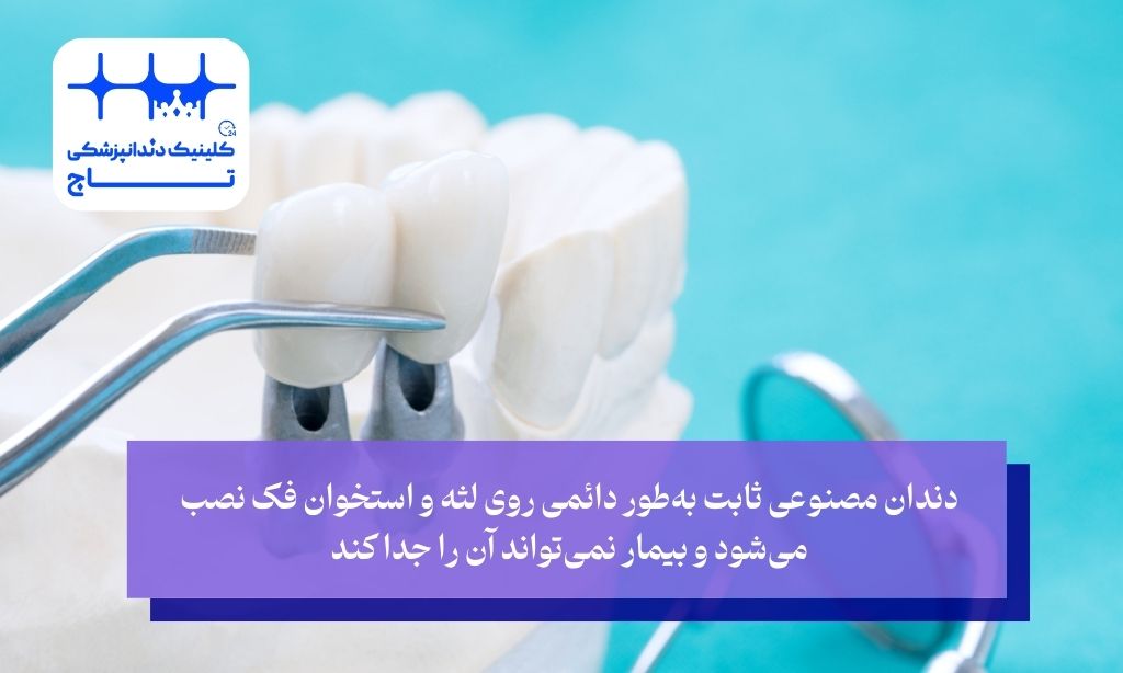 دندان مصنوعی ثابت