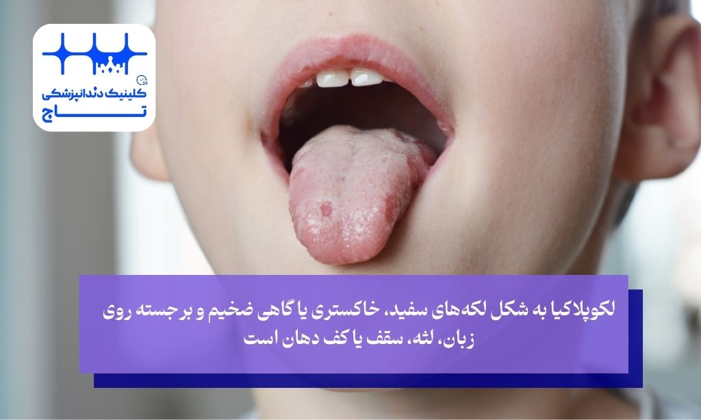 لوکوپلاکی چه شکلی است