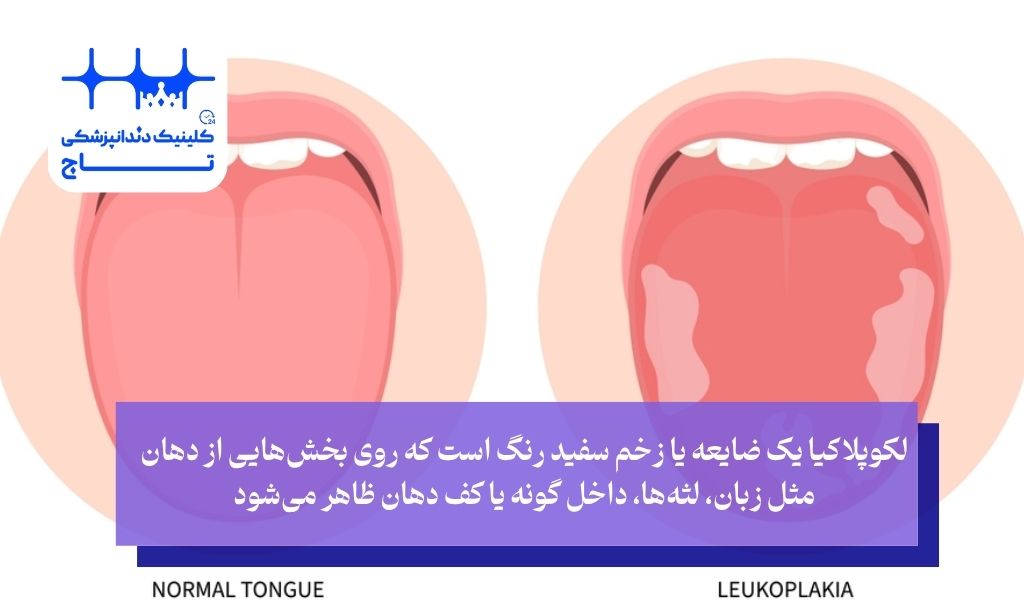 لکوپلاکیا چیست