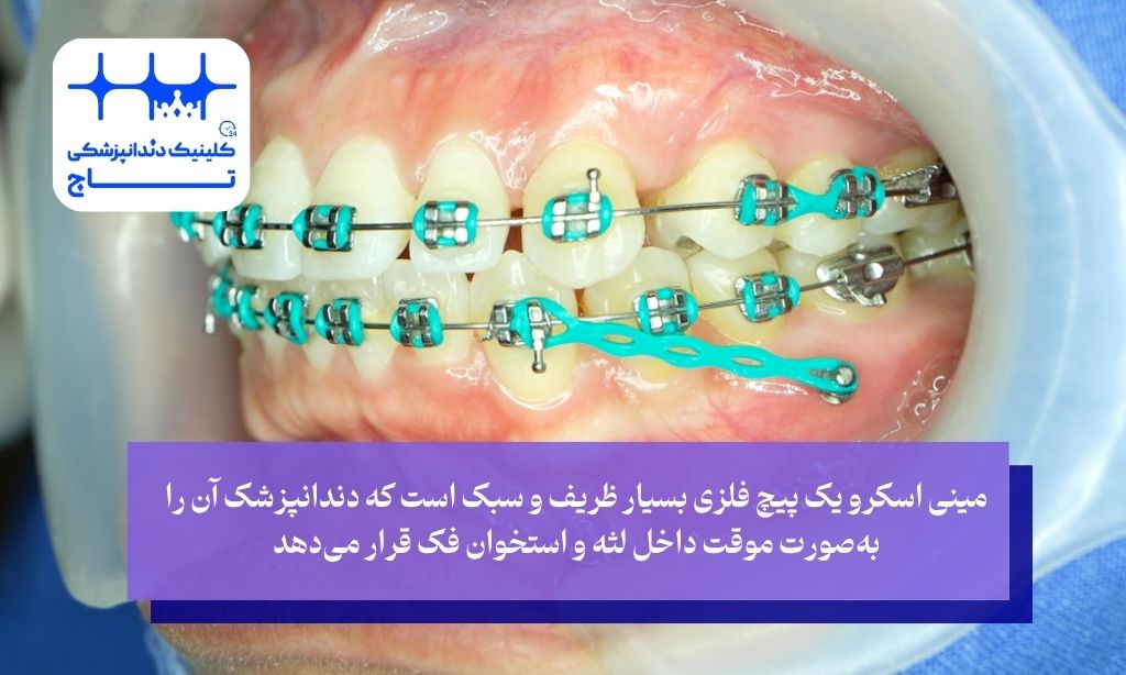 مینی اسکرو چیست