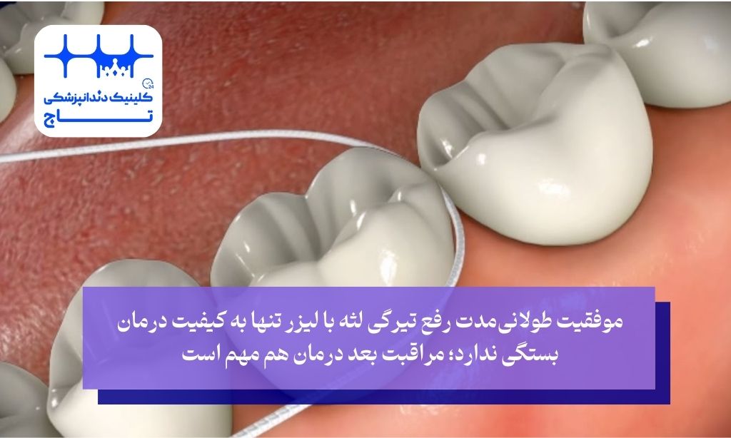 تضمین بهترین نتیجه از رفع تیرگی لثه با لیزر