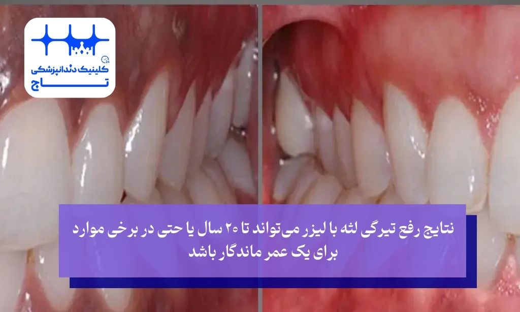 تغییر رنگ لثه با لیزر