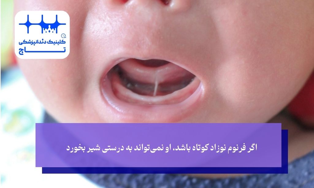 جراحی بند زیر زبان نوزاد؛ نجات تغذیه و گفتار (Ankyloglossia)