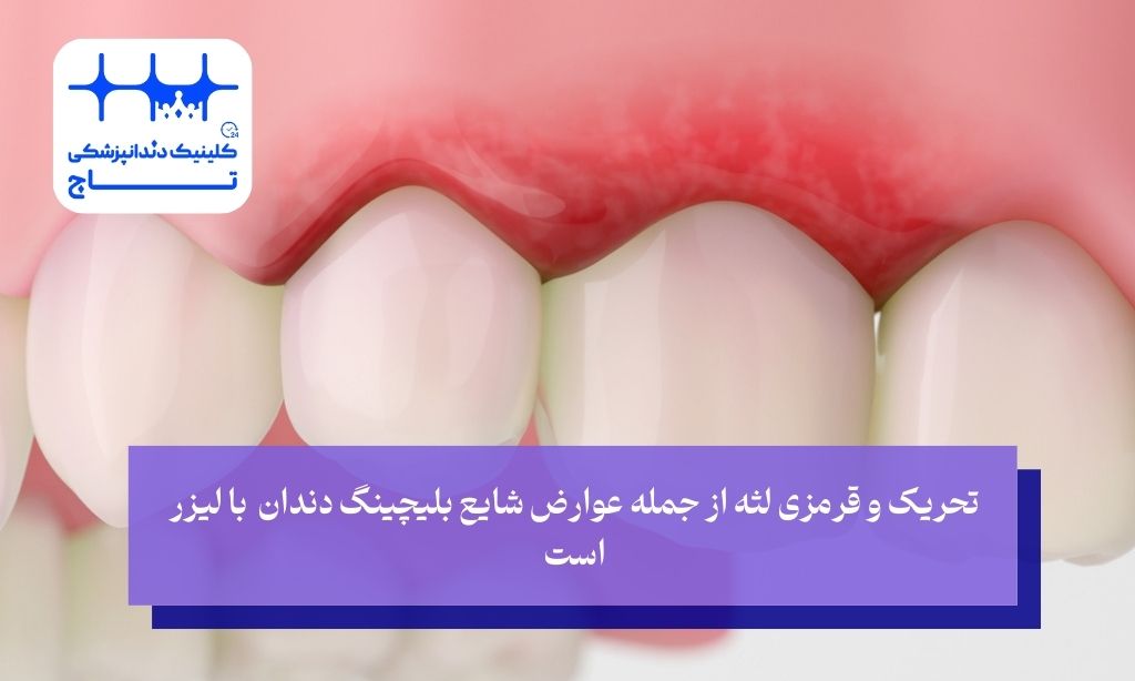 عوارض بلیچینگ دندان با لیزر