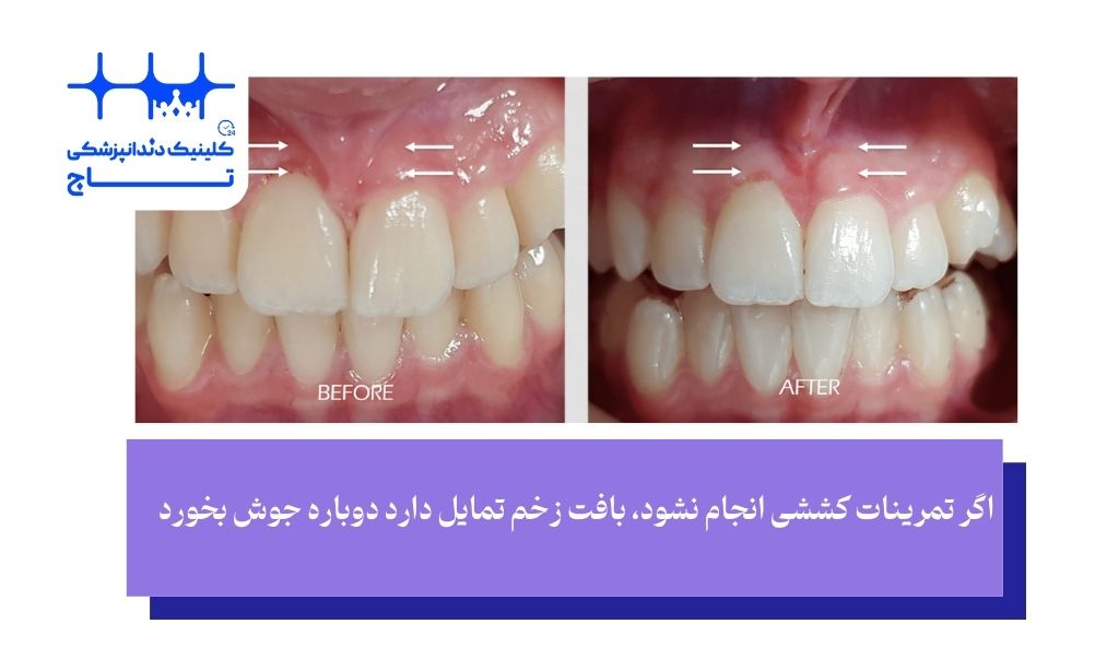 عوارض فرنکتومی با لیزر