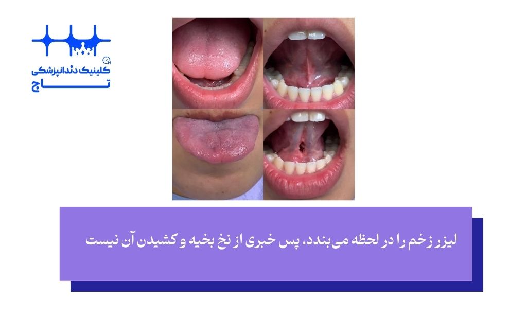 مزایای فرنکتومی با لیزر