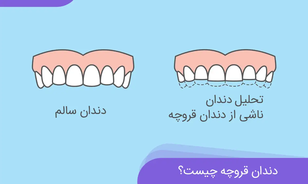 دندان قروچه چیست و چطور آن را متوقف کنیم؟ | تاج دنتال کلینیک