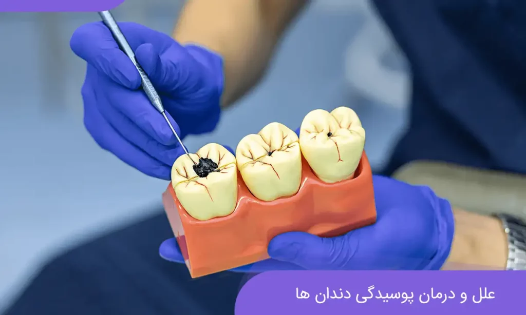 پوسیدگی دندان عکس