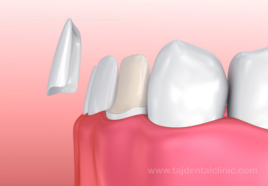 فاصله بین دندان‌ها