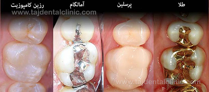 انواع پر کردن دندان شیری کودکان