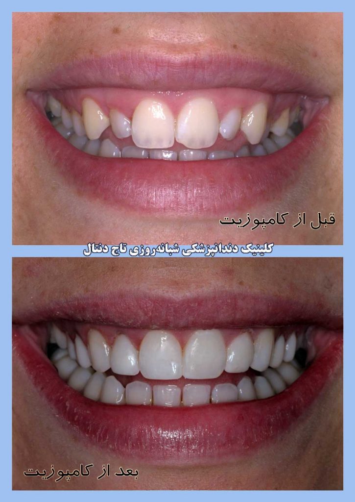 کامپوزیت دندان جلو