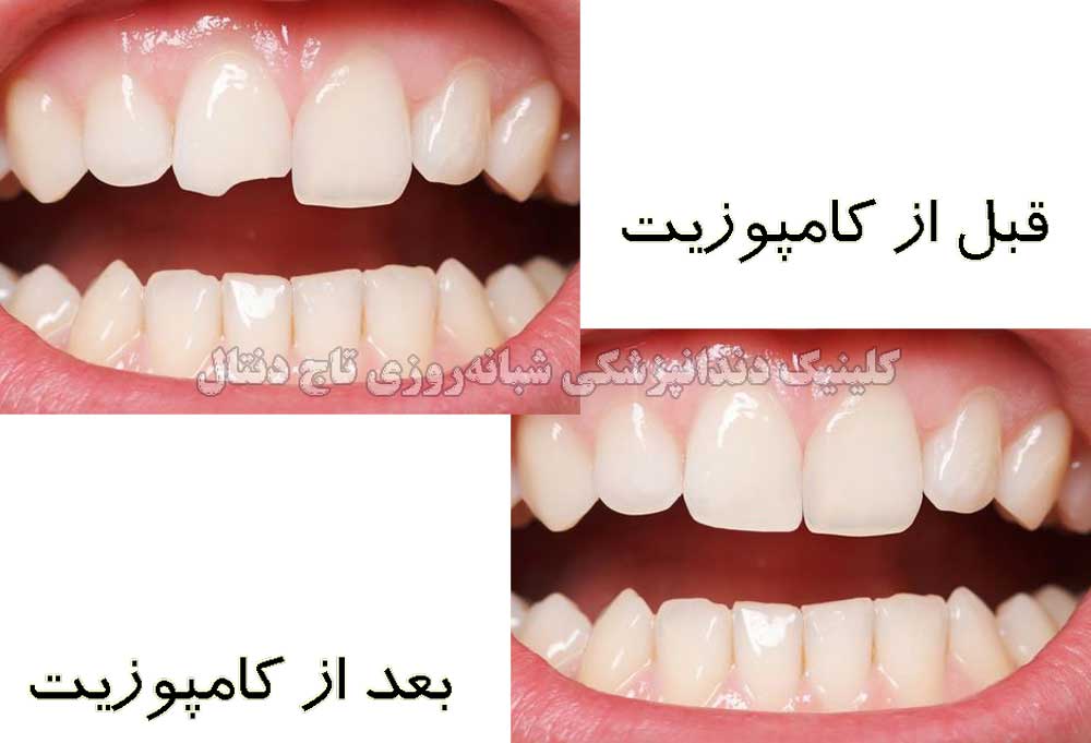 کامپوزیت زیبایی دندان جلو