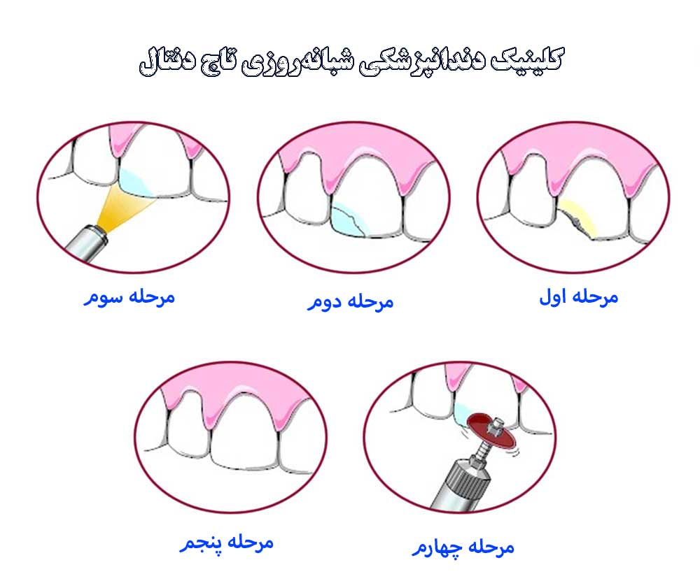 مراحل کامپوزیت کردن دندان