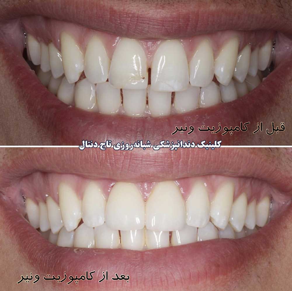 قبل و بعد از کامپوزیت ونیر دندان