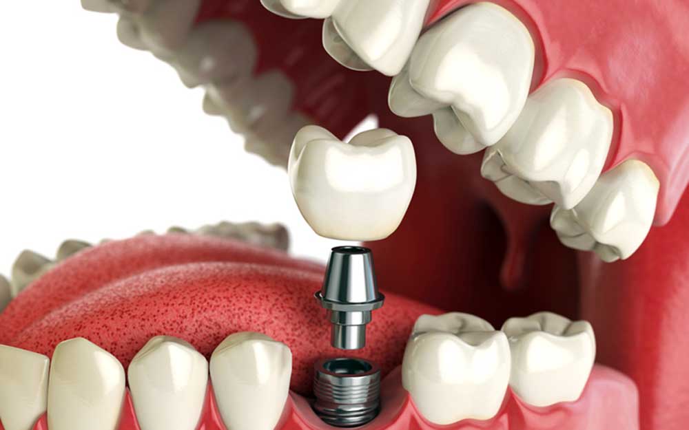 تصویر شماتیک یک واحد ایمپلنت دندان