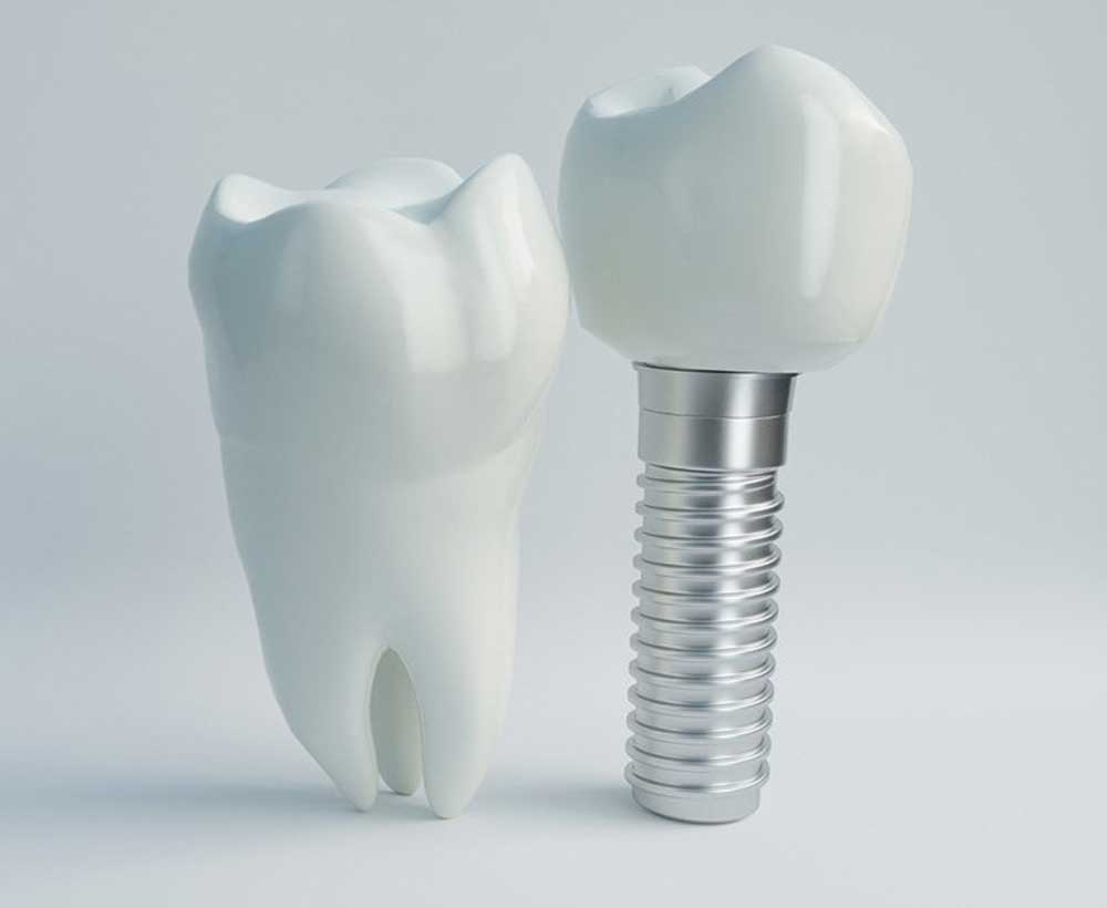 مقایسه دندان واقعی و ایمپلنت دندان