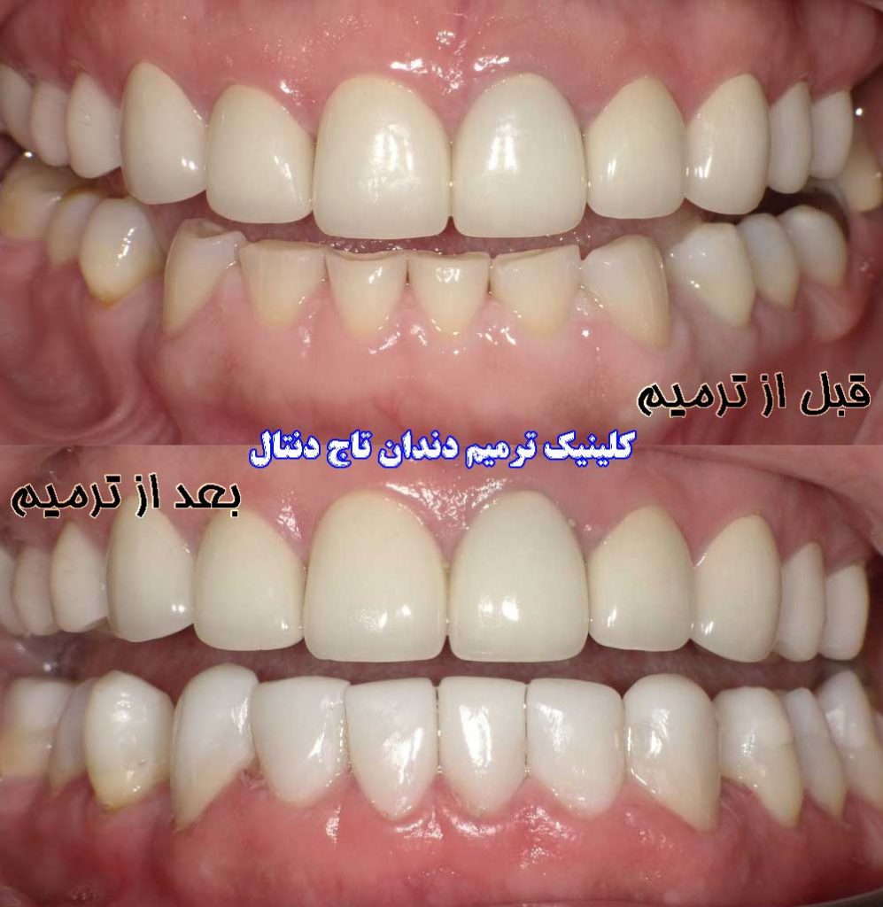 قبل و بعد از ترمیم دندان