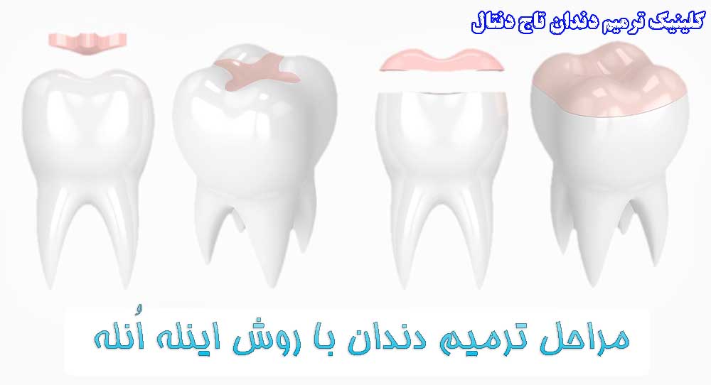 وش اینله انله در تریمی و زیبایی دندان