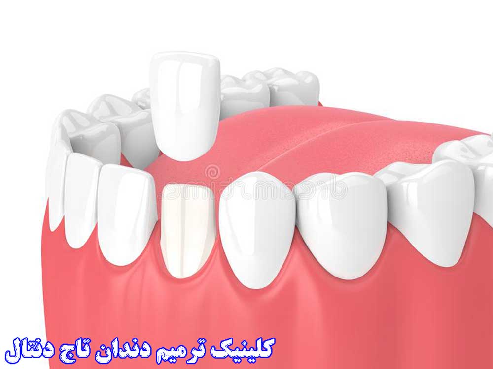 روکش ترمیمی دندان