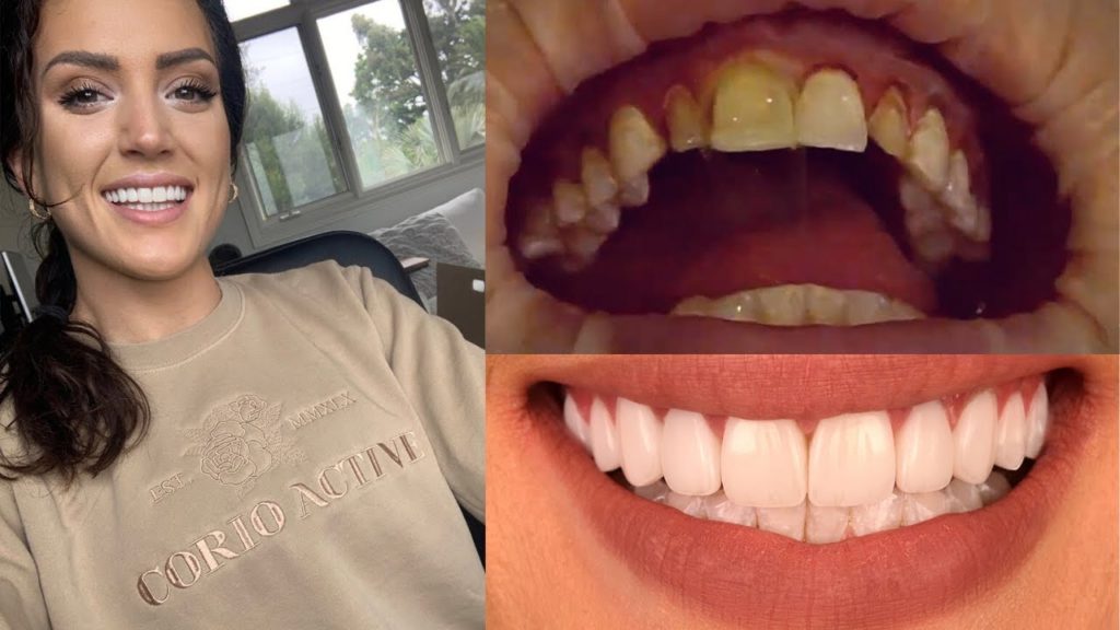 تصویر قبل و بعد خانمی که کامپوزیت ونیر دندان انجام داده است