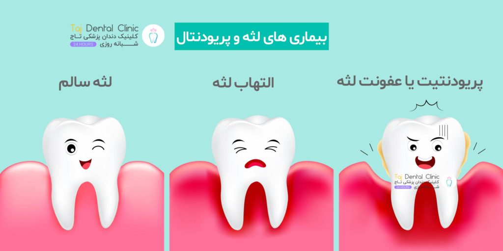 اینفوگرافی بیماری لثه