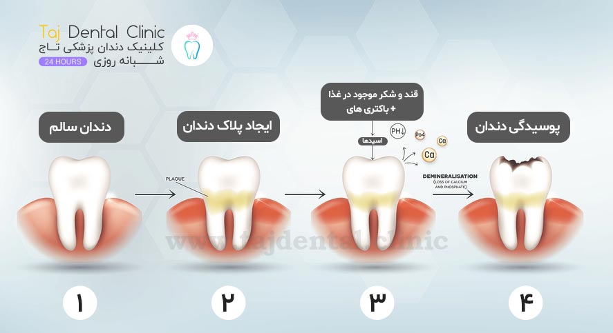 اینفوگرافی روند شکل گیری پلاک و جرم دندان