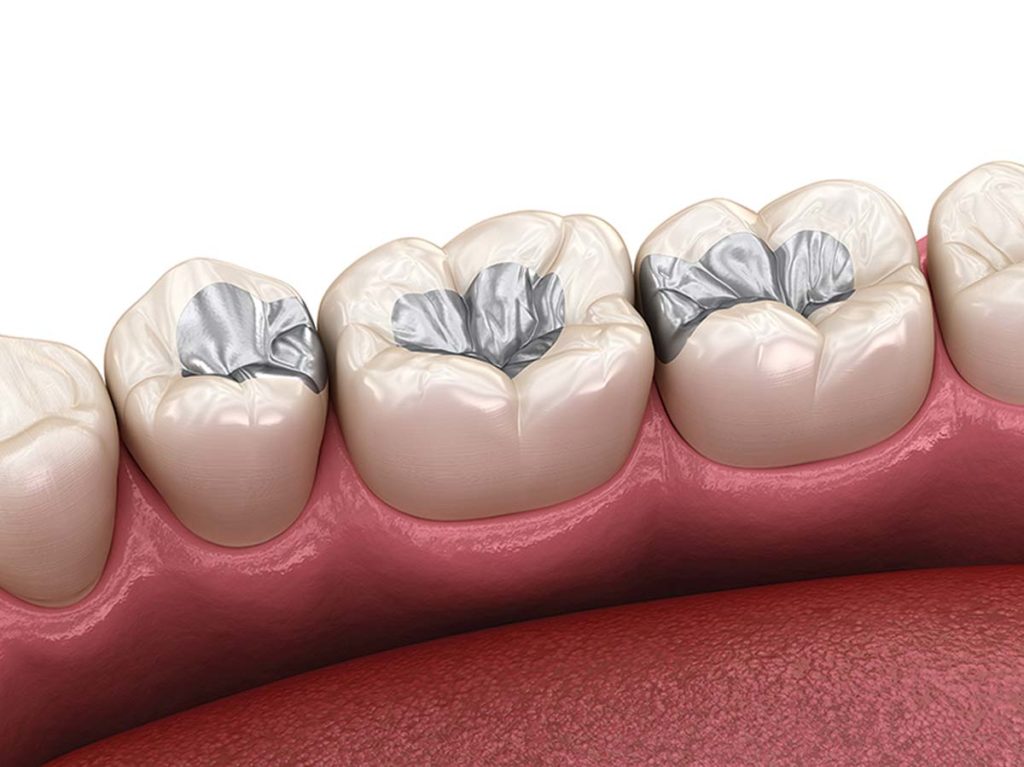مزایا و معایب ترمیم دندان با مواد آمالگام