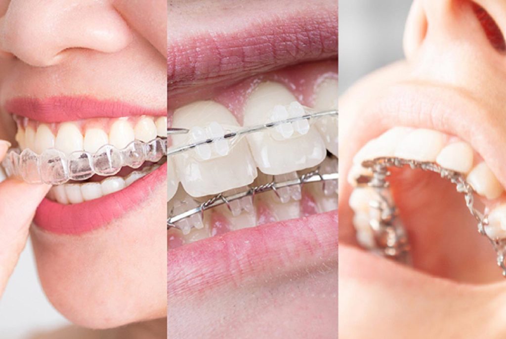 اشکال مختلف ارتودنسی نامرئی