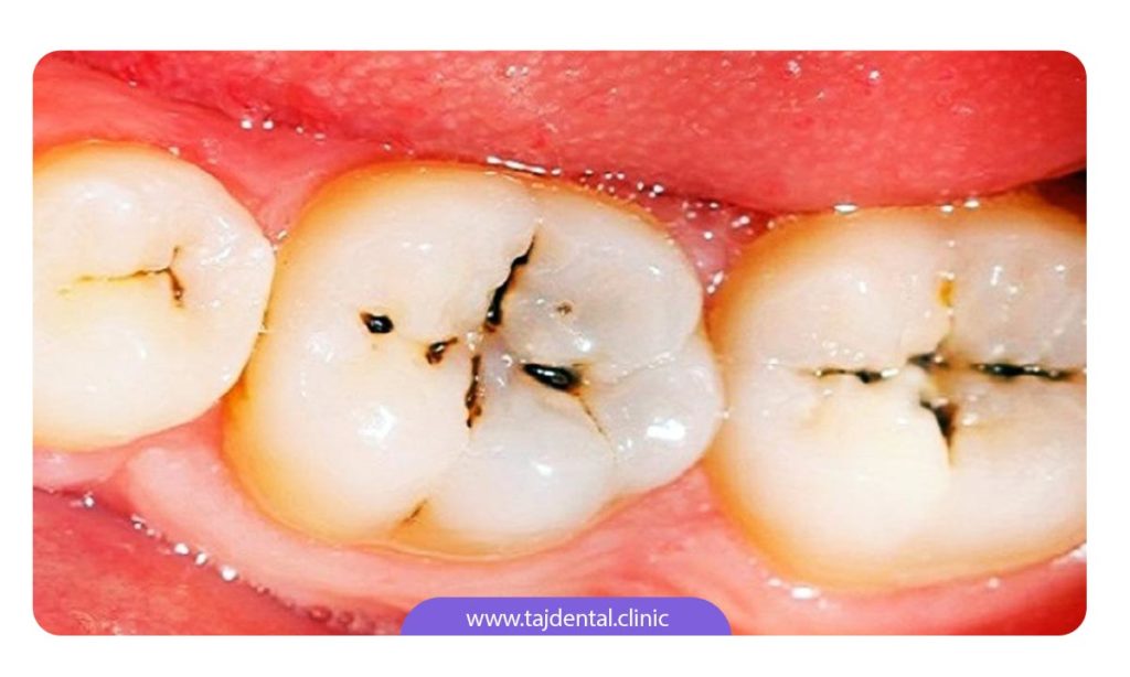 عکس چند دندان پوسیده یک کودک که تحت ویزیت متخصص دندانپزشکی کودکان است