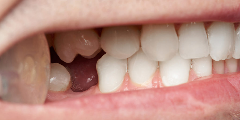 تصویر دهان یک شخص که یکی از دندان های آسیاب آن غائب است