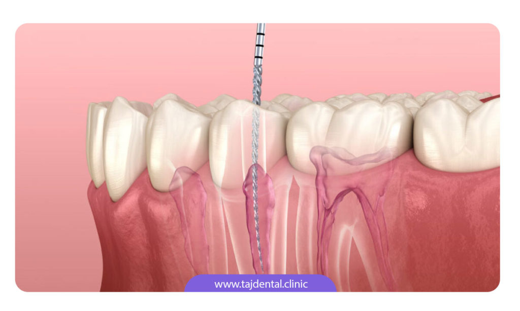 تصویر عصب کشی دندان کودکان به صورت شماتیک
