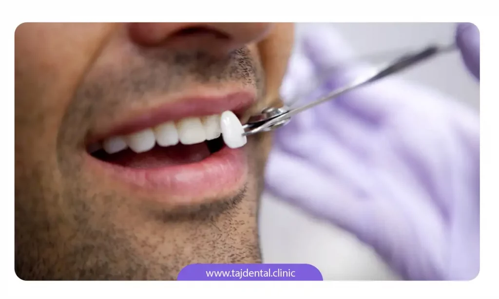 تصویر لمینت دندان قبل از اتصال به دندان بیمار