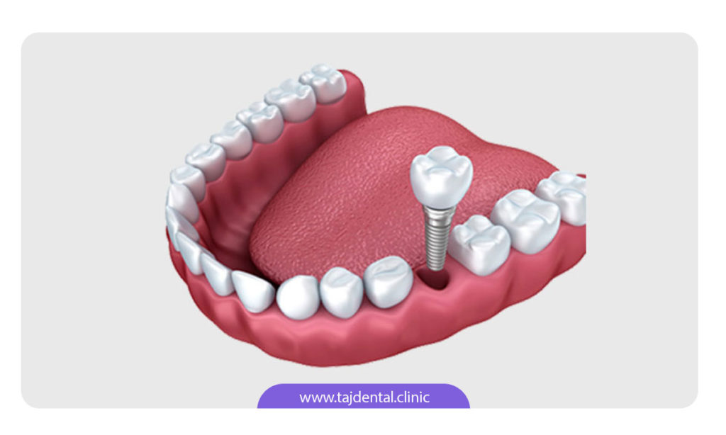 تصویر شماتیک یک واحد ایمپلنت دندان در یک فک