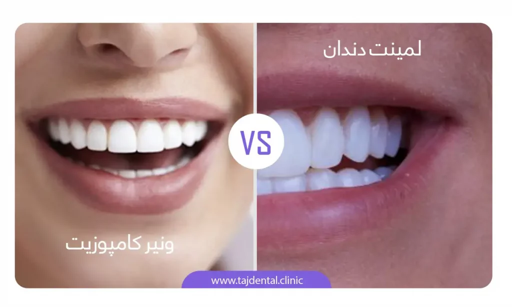 عکس تفاوت لمینت و کامپوزیت دندان